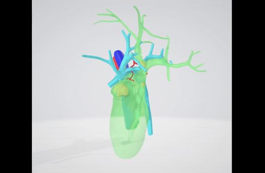 bile-duct-stone-biliary-gall-1.gif Calcul du canal cholédoque