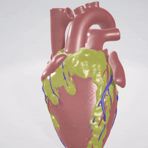 Detailed 3D Model of an Obese Heart – "FATTY HEART" 3D model