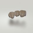 bridge.gif STL file Dental bridge・3D printing model to download