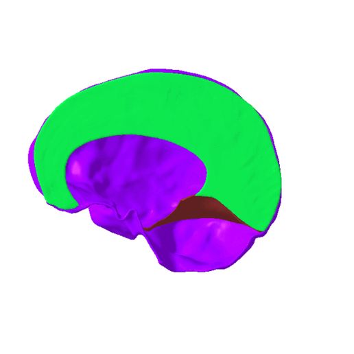 11.gif Subdivision of cranial dura mater SEGMENTED IN 3 PARTS